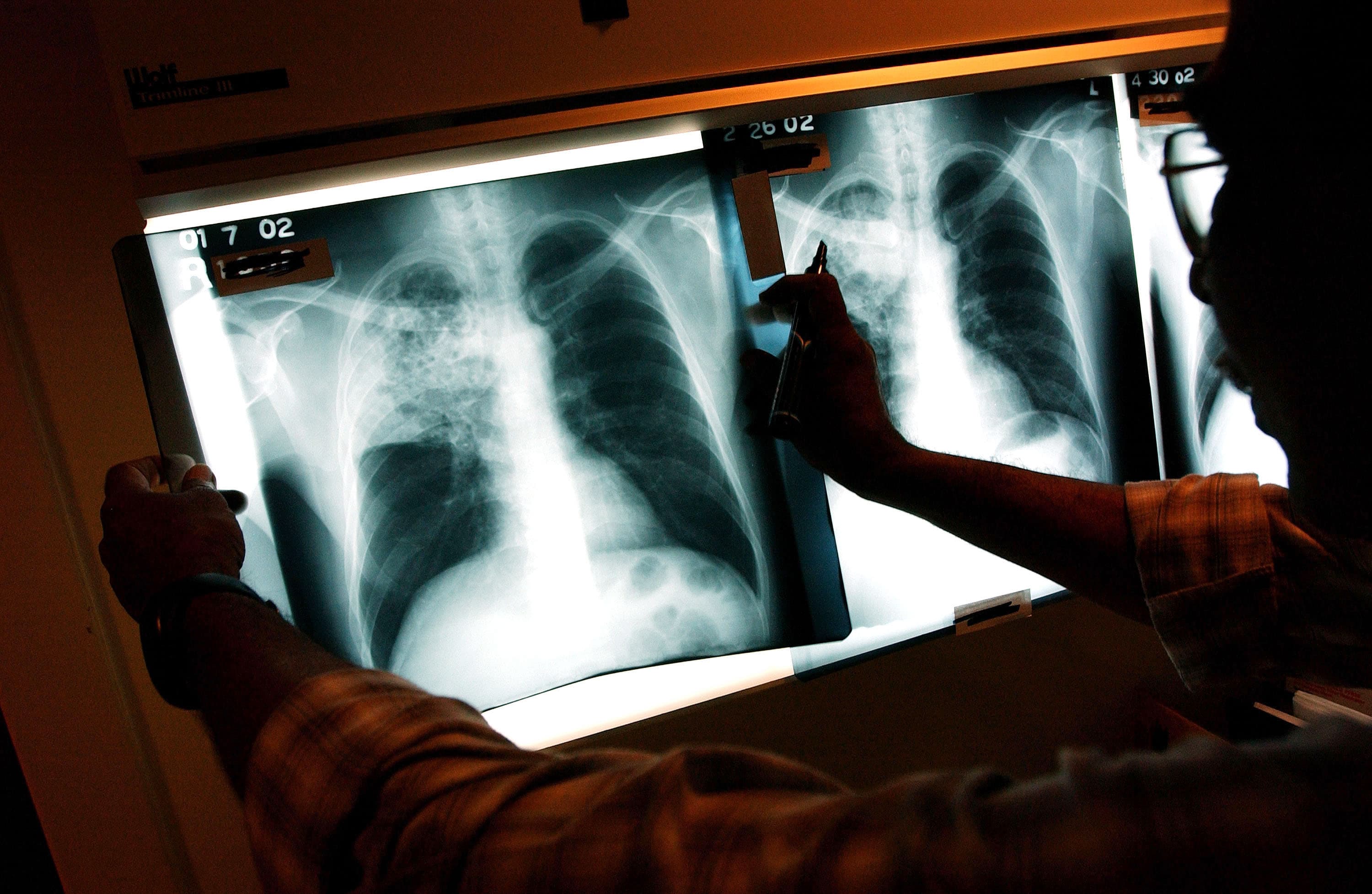 Tuberculosis Cases in the United States Remain at Alarming 14-Year High Despite Slight 2025 Dip — Four States Report Double-Digit Surges and the Elderly Are at Growing Risk